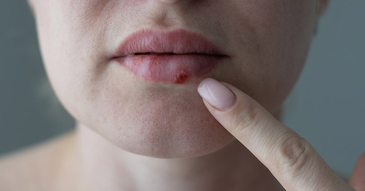 Después de casi treinta años, un comprimido nuevo contra el herpes que no responde a los tratamientos clásicos