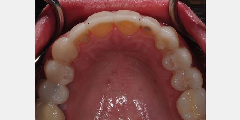 Carillas dentales: los bordes que avisan antes de una filtración